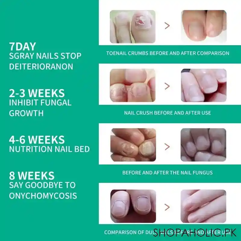 nail fungus solution image3