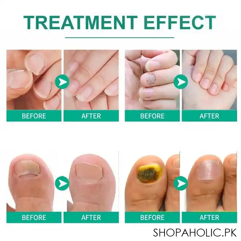 nail fungus solution image5